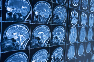 How Levine & Slavit, PLLC Can Help With a Brain Injury in New York